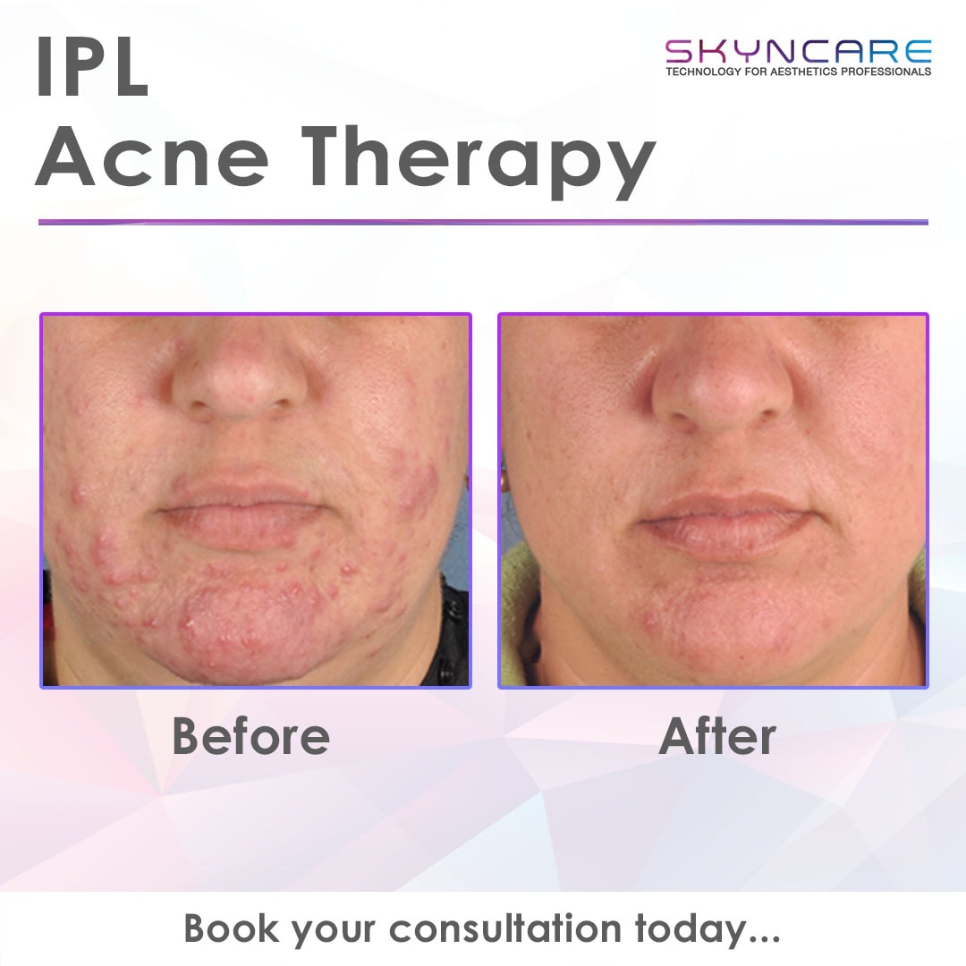 IPL Acne Therapy before and after results