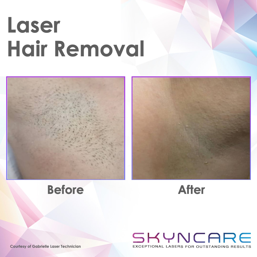 IPL Hair Removal before and after results