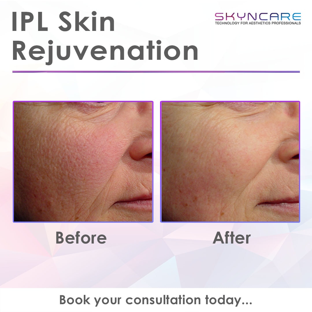 IPL Skin Rejuvenation before and after results
