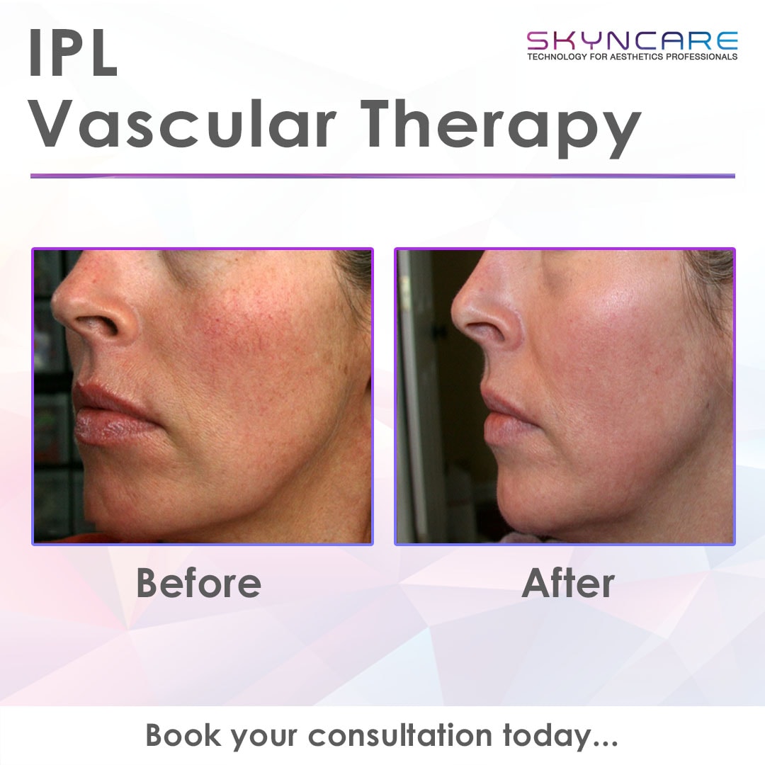 IPL Vascular Therapy before and after results